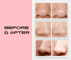 PureGlow Vacuum Pore Cleaner – Deep Cleansing Blackhead Remover for Clearer Skin